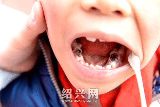 “微笑爱牙”抽检发现:300名小学生乳牙龋坏率达六成[绍兴网-新闻中心]